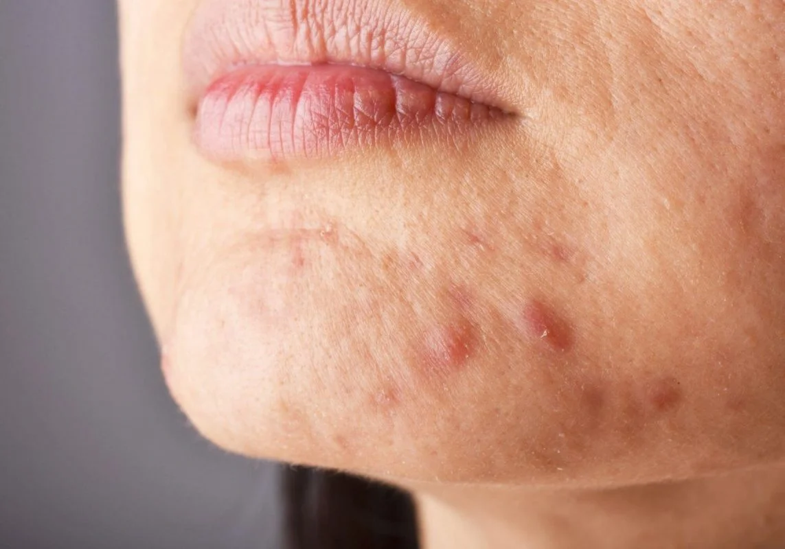 Woman with Acne